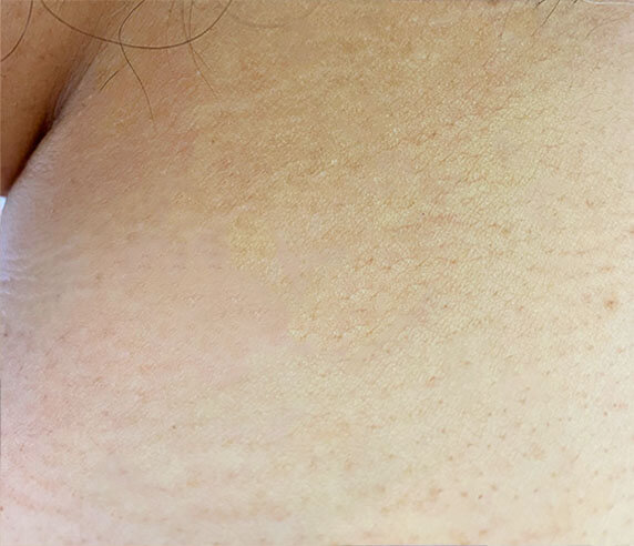 DERMATOLOGÍA QUIRÚRGICA 2
