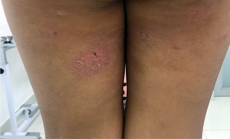 PRUEBAS DE ALERGIAS A LA PIEL 2