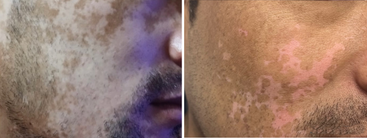 Vitiligo